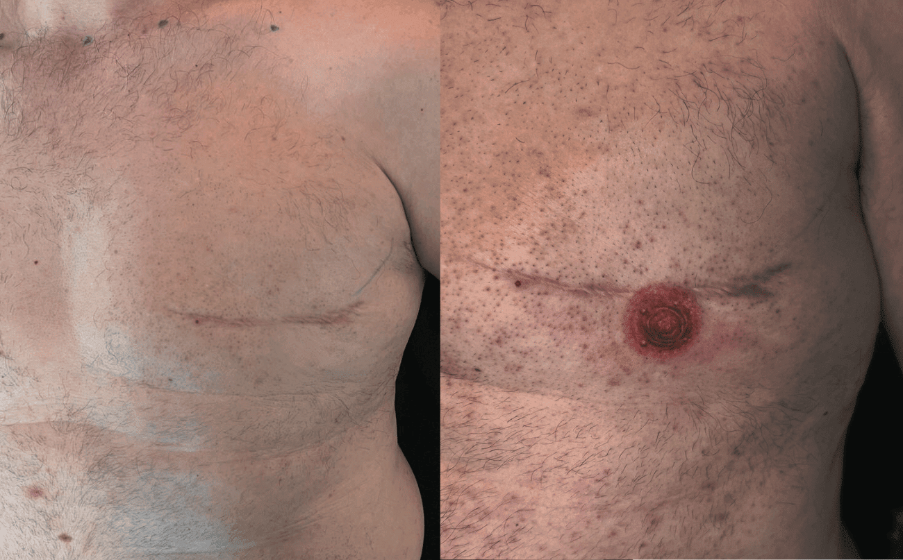 Realistische tepel en areola tattoo na borstamputatie.